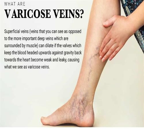 Royal prestige varicose veins patch 2 Pack