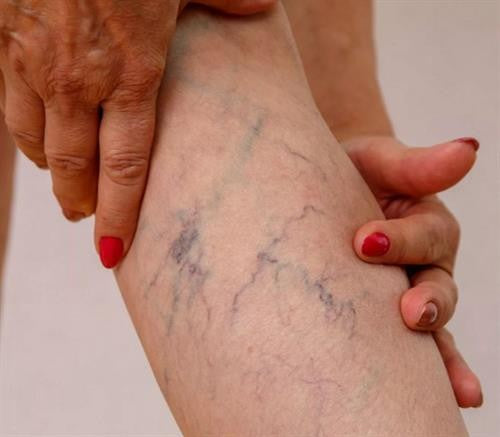 Royal prestige varicose veins patch 2 Pack